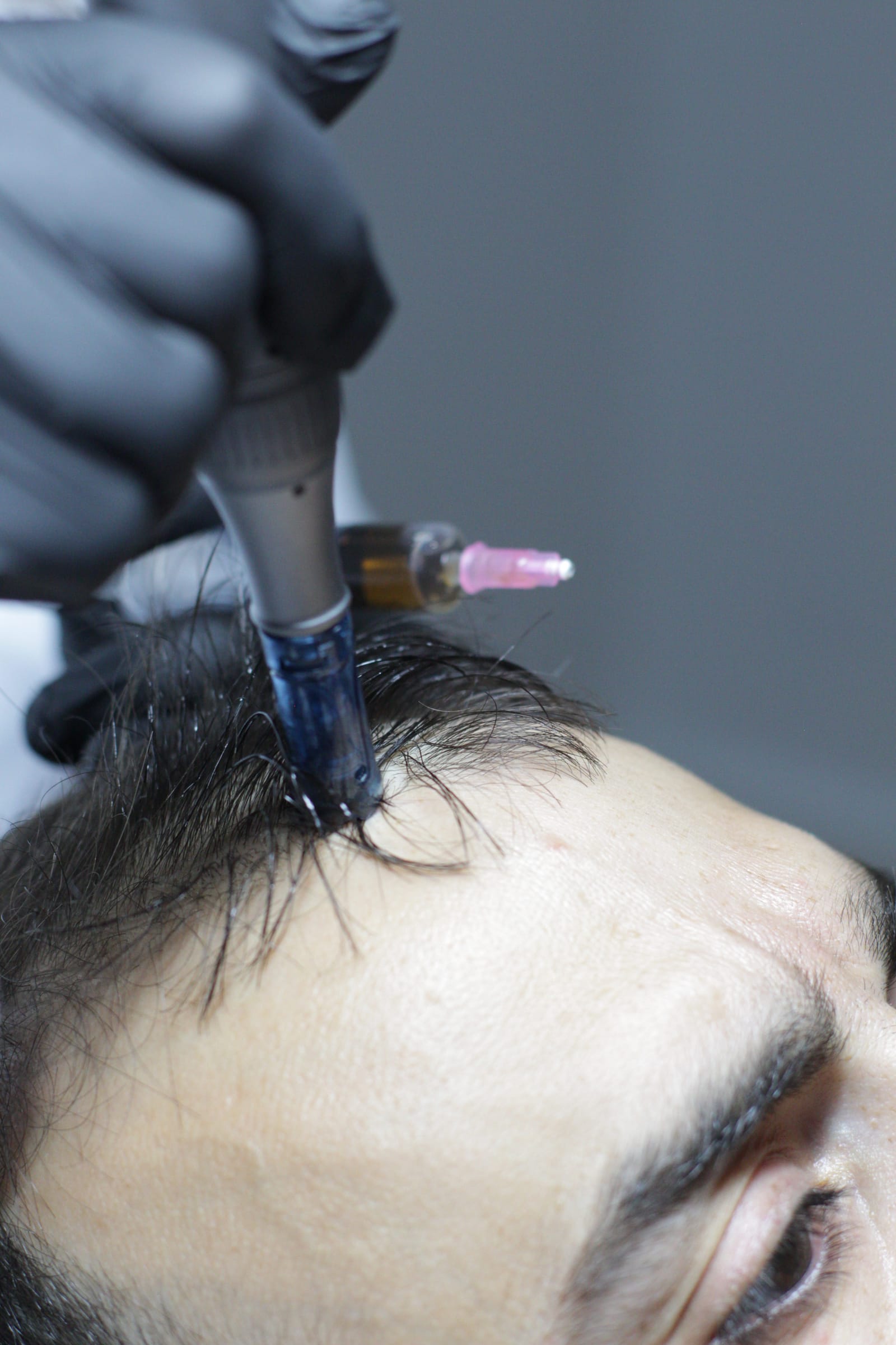 Pure Aesthetics Malta - scalp and hair clinic in Birkirkara, photo 4